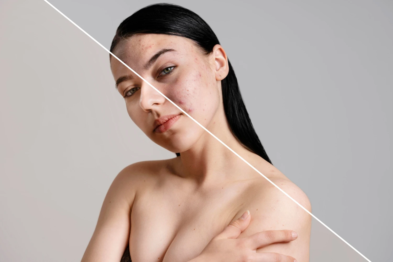 Understand Acne: Causes, Types, and Treatments a woman with her arm around her chest and a line across her chest to show the size of her breast