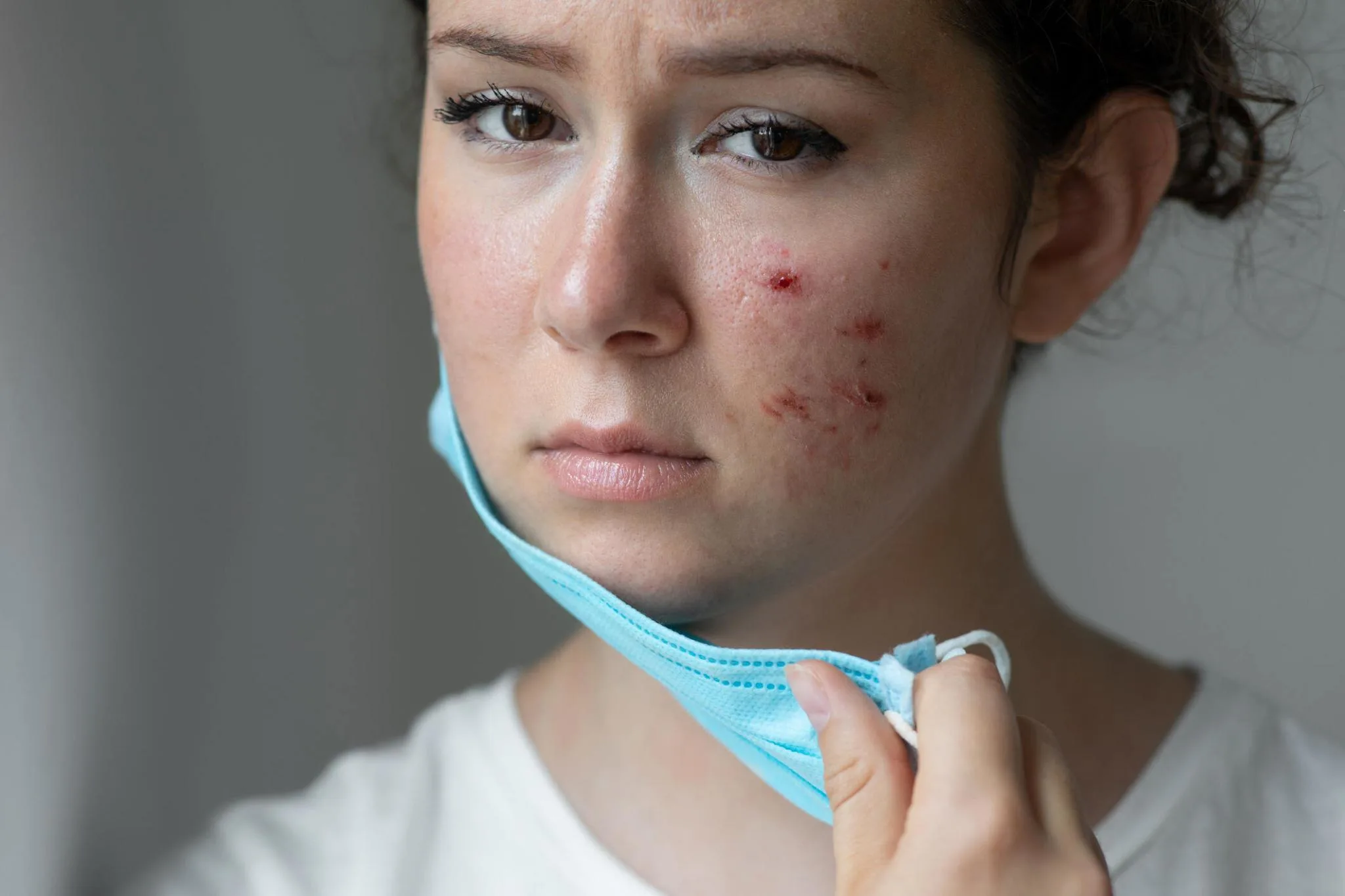 Transforming Your Skin: Tretinoin's Acne Scar Journey